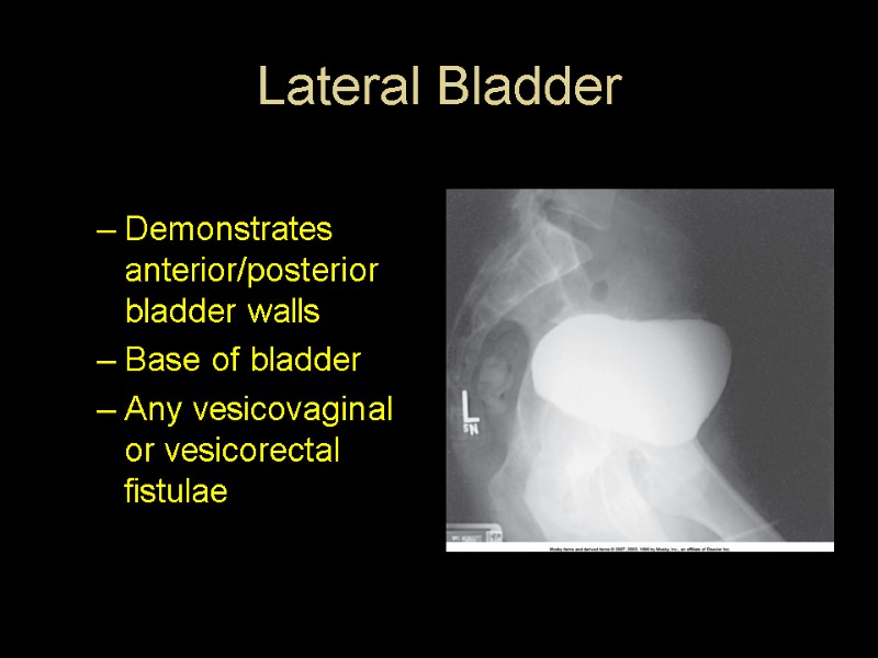 Lateral Bladder  Demonstrates anterior/posterior bladder walls Base of bladder Any vesicovaginal or vesicorectal